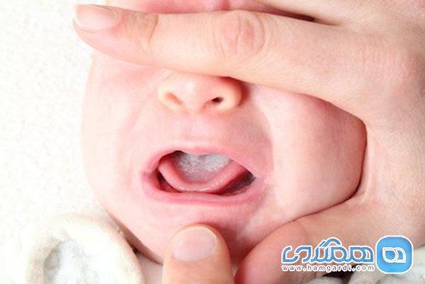 برفک دهان؛ یکی از مسائل دهانی شیرخواران