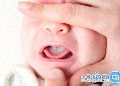 برفک دهان؛ یکی از مسائل دهانی شیرخواران