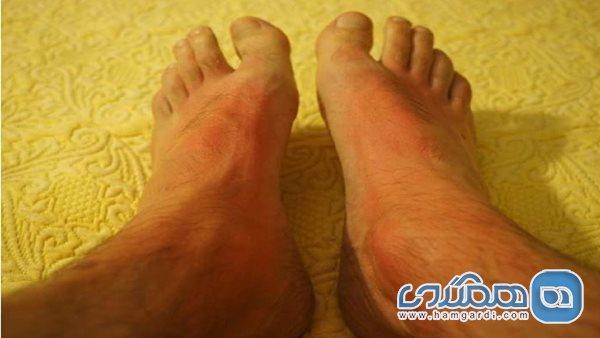رنگ تیره پوست؛ دفاع طبیعی بدن در برابر سرطان ناشی از اشعه رنگ تیره پوست؛ دفاع طبیعی بدن در برابر سرطان ناشی از اشعه ماوراءبنفش