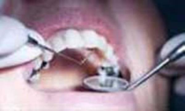 یافته های محققان درباره پوسیدگی دندان