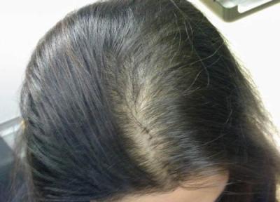 بررسی علل ریزش مو در زنان